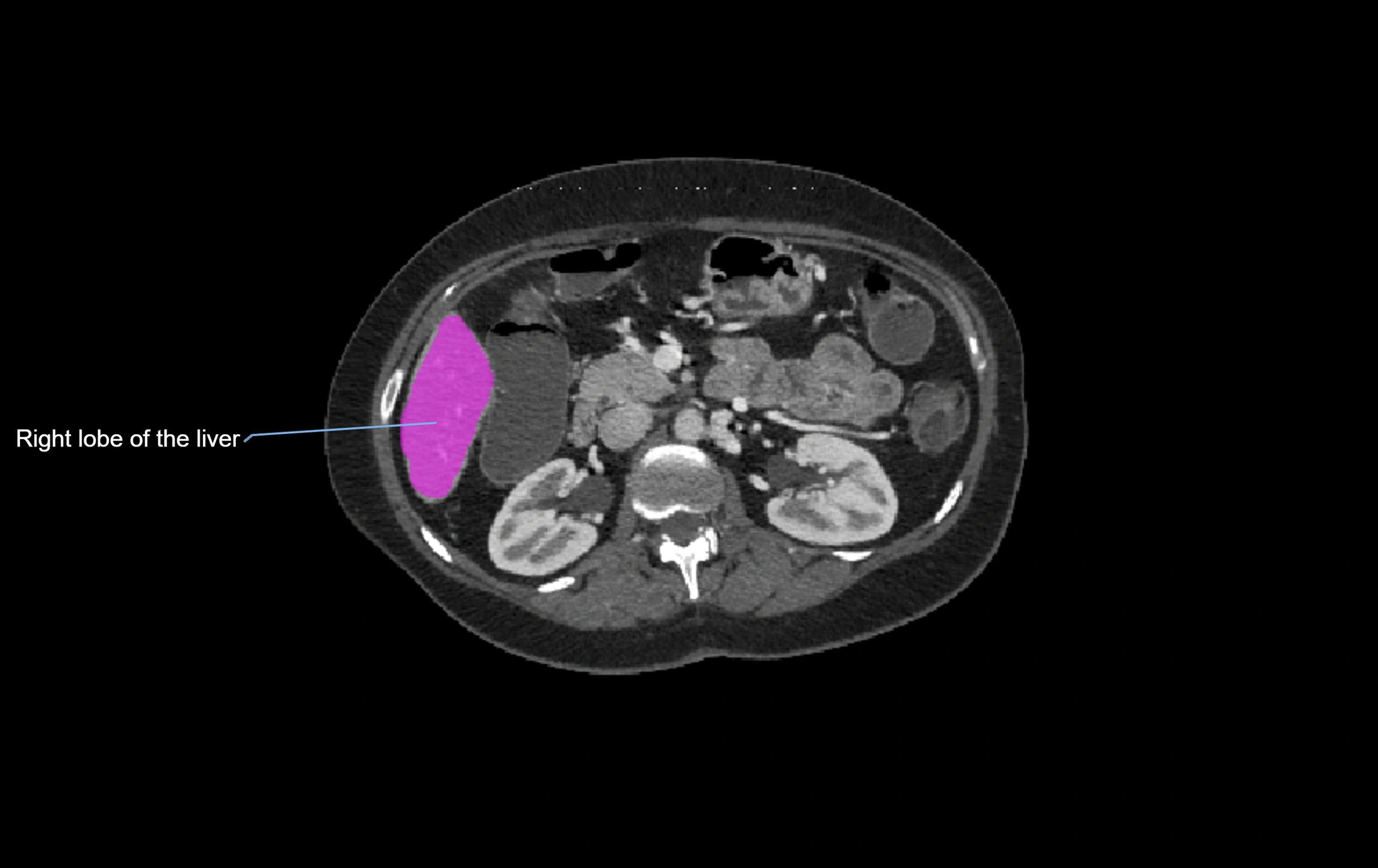 CT lliver lobes axial cross sectional anatomy labelled image -00022.webp